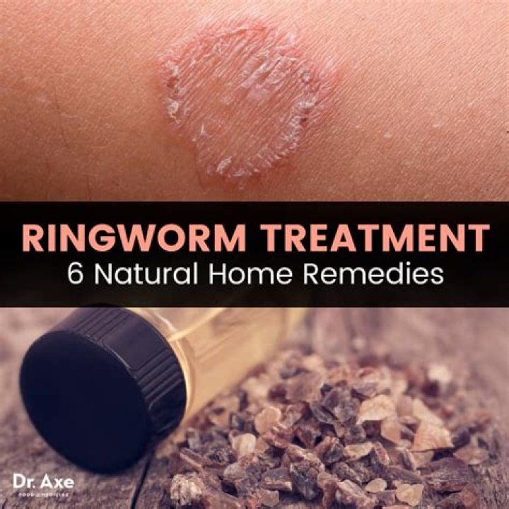 What kills ringworm naturally?