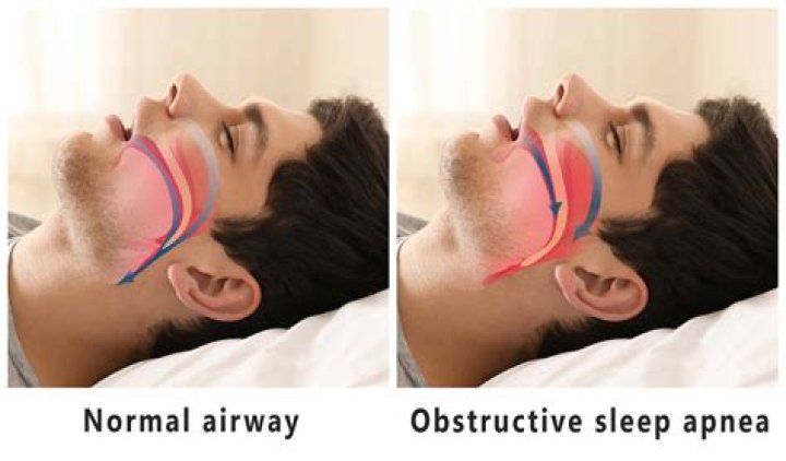 What organs does sleep apnea affect?