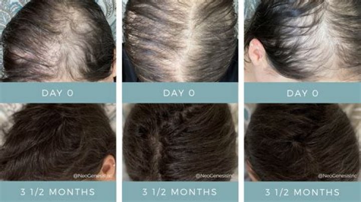 What percentage of chemo patients lose their hair?