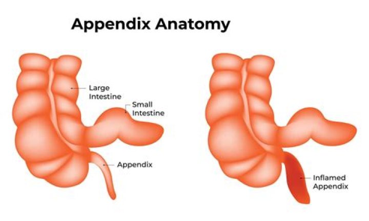 What side is your appendix on female?