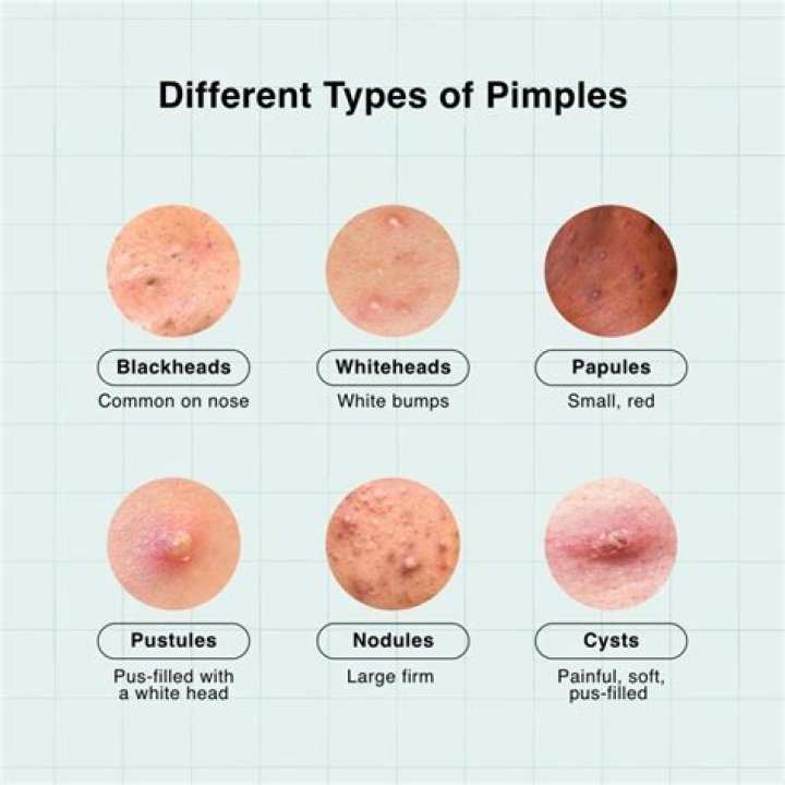 What to put on a pimple to make it pop?
