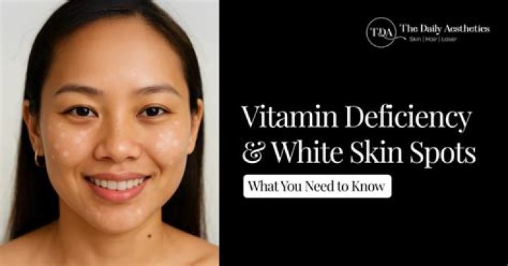What vitamins are good for white spots on skin?