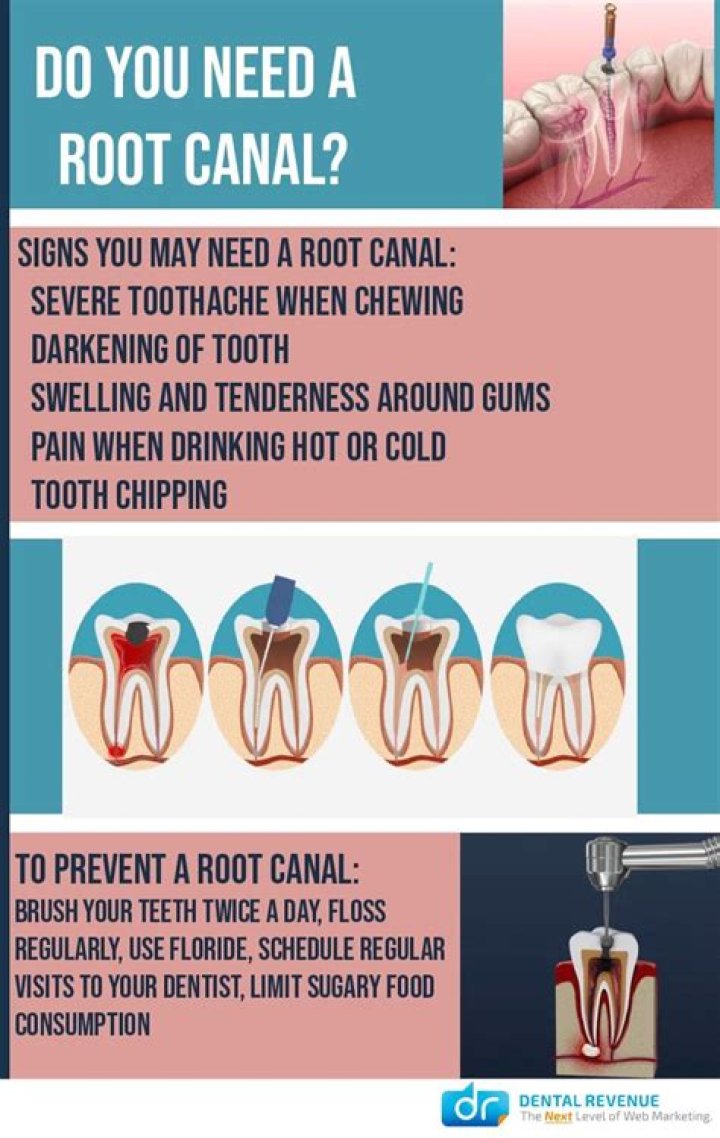 When does a tooth need a root canal?