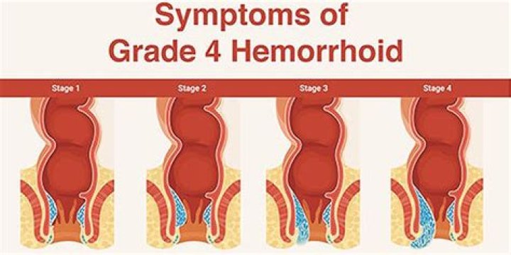 When is a hemorrhoid an emergency?
