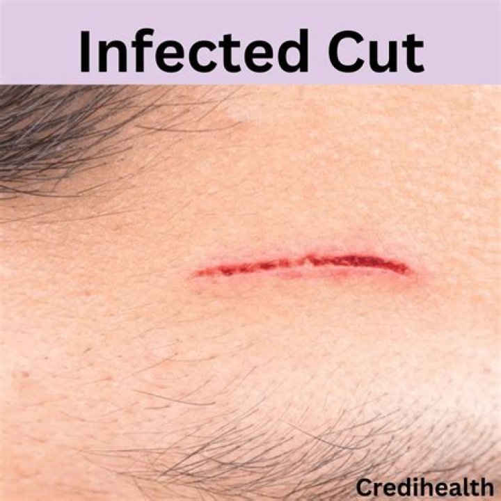 When should I see a doctor for an infected cut?