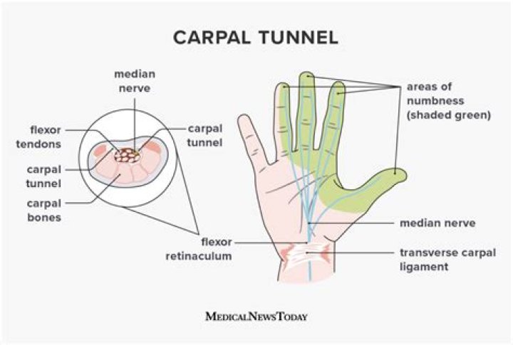 Which fingers does carpal tunnel affect?