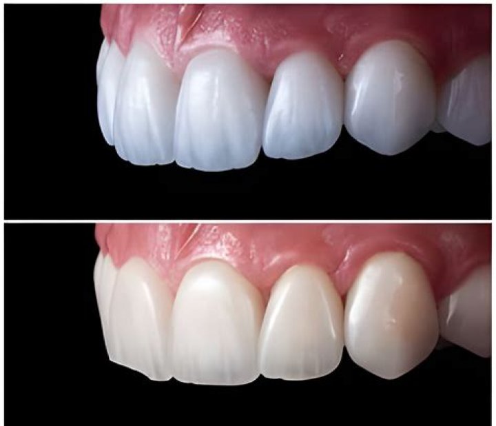 Which is better zirconia or porcelain crown?
