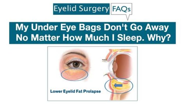 Why do I have Eyebags even though I sleep early?