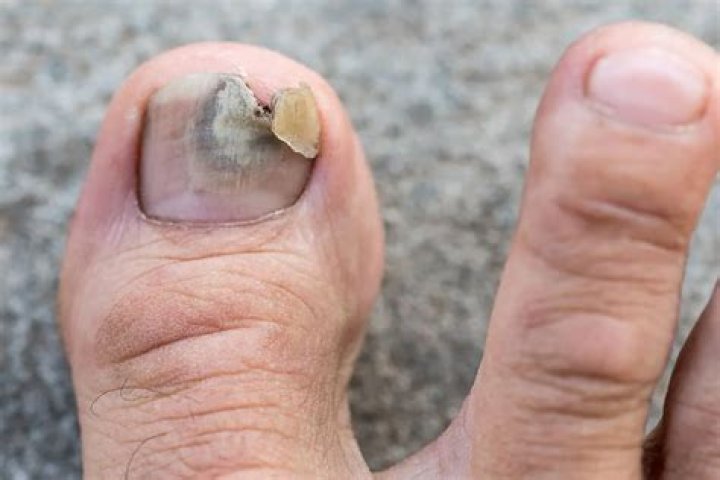 Why do my toenails hurt at night?