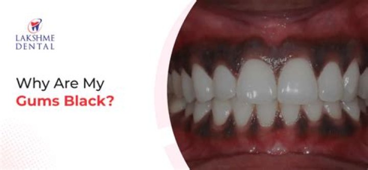 Why is my gum black?