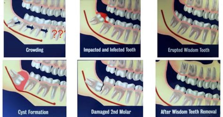 Why is my permanent tooth moving?