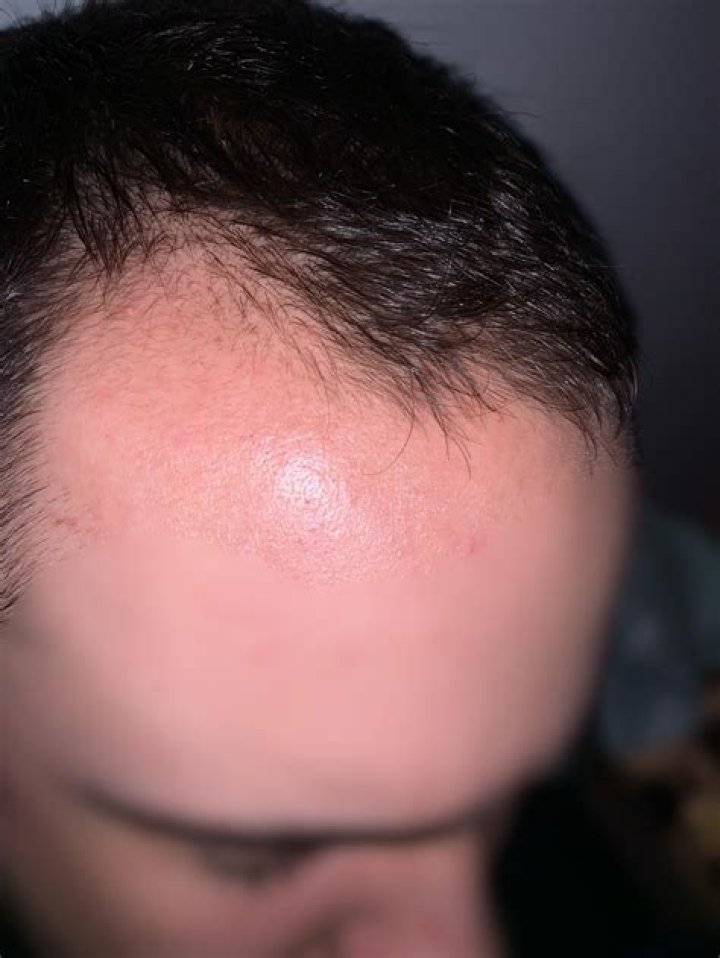 Will my hairline grow back?